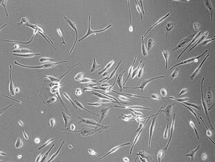 Frisch isolierte Glioblastomzellen eines Patienten in der Zellkultur (400-fache Vergrößerung). © Prof. Temme, Uniklinikum Dresden. © Prof. Temme, Uniklinikum Dresden