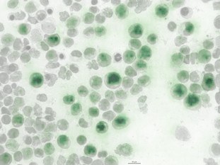 Knochenmarkausstrich eines AML-Patienten. Die neu entwickelte Analysesoftware erkennt eine bestimmte genetische Mutation anhand äußerer Zellmerkmale (dunkelgrüne Färbung). © MK1/Uniklinikum Dresden